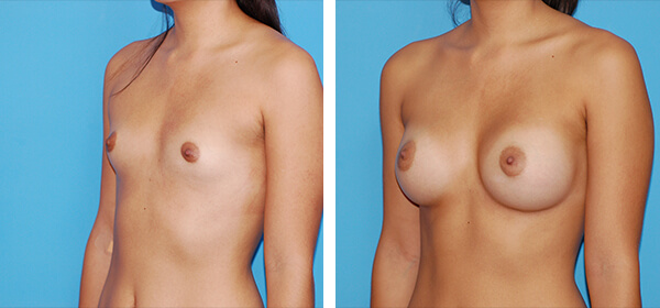 , Breast Augmentation &#8211; Patient 55
