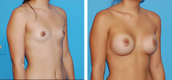 , Breast Augmentation – Patient 55