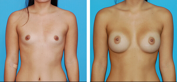, Breast Augmentation – Patient 55