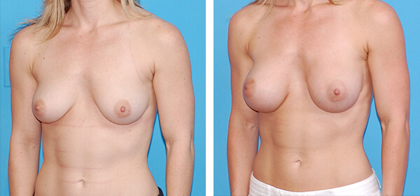 , Breast Augmentation &#8211; Patient 57