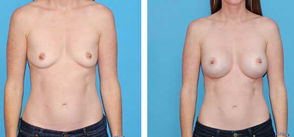 , Breast Augmentation &#8211; Patient 59