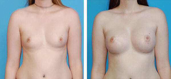 , Breast Augmentation &#8211; Patient 56