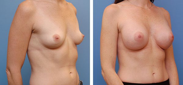 , Breast Augmentation – Patient 22