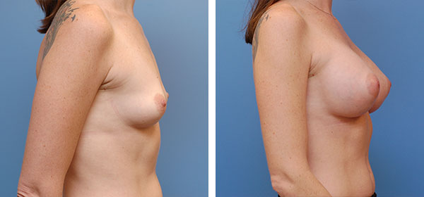 , Breast Augmentation – Patient 22