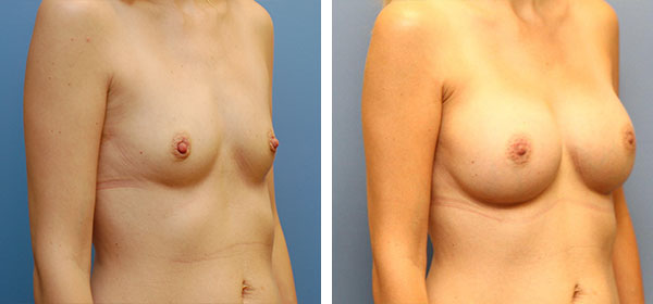 , Breast Augmentation – Patient 24