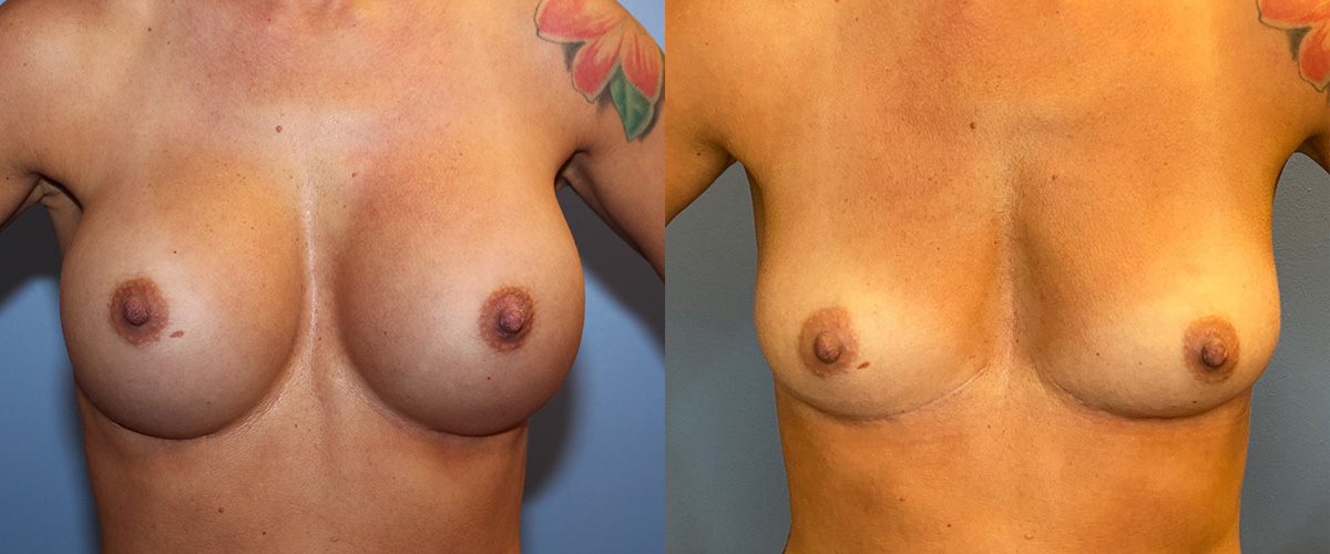 , Breast Explant Surgery